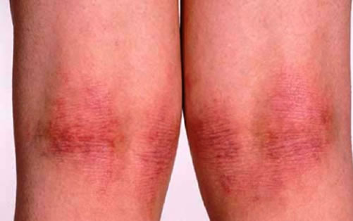 Dyshidrotic eczema on back of knees