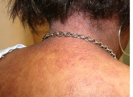 Eczema Keratosis Pilaris