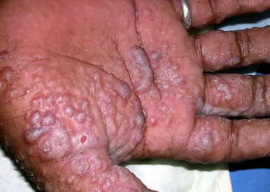 Severe Dyshidrotic eczema on hands
