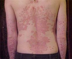 Eczema On Back